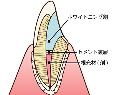 ウォーキングブリーチ