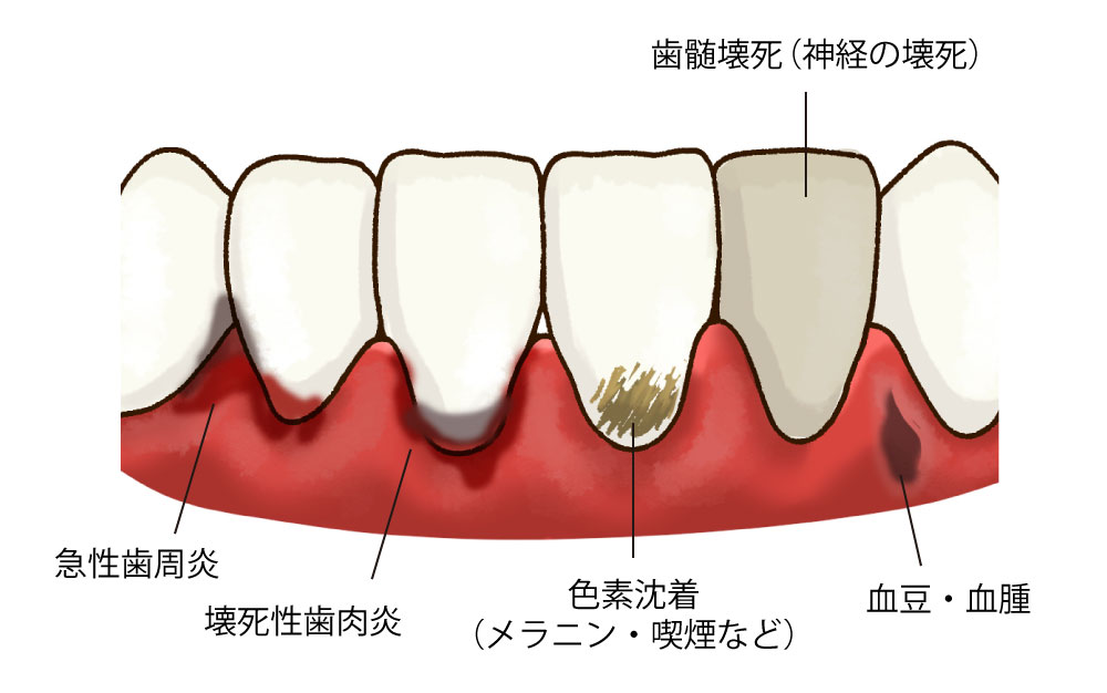 歯茎が黒い症状のイラスト｜福岡市南区 大橋THREE歯科・矯正歯科