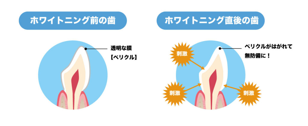 ホワイトニング前に歯の表面のペリクルを除去するイラスト｜福岡市南区 大橋THREE歯科・矯正歯科