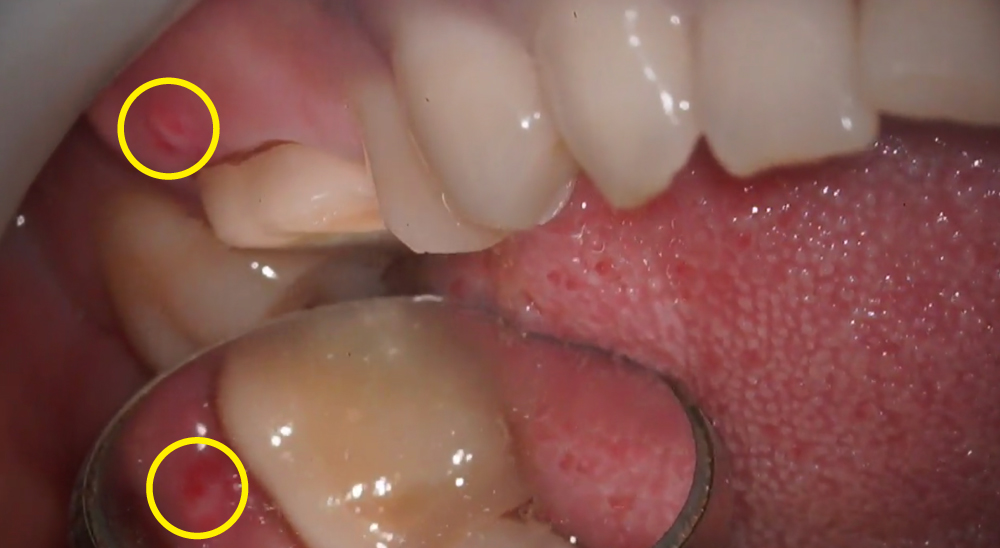 歯茎 白いできもの 画像