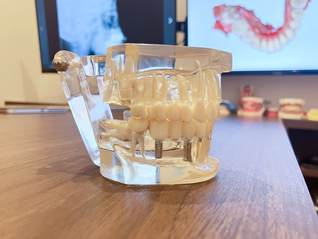 インプラントのネジ　大きさ　大橋THREE歯科・矯正歯科