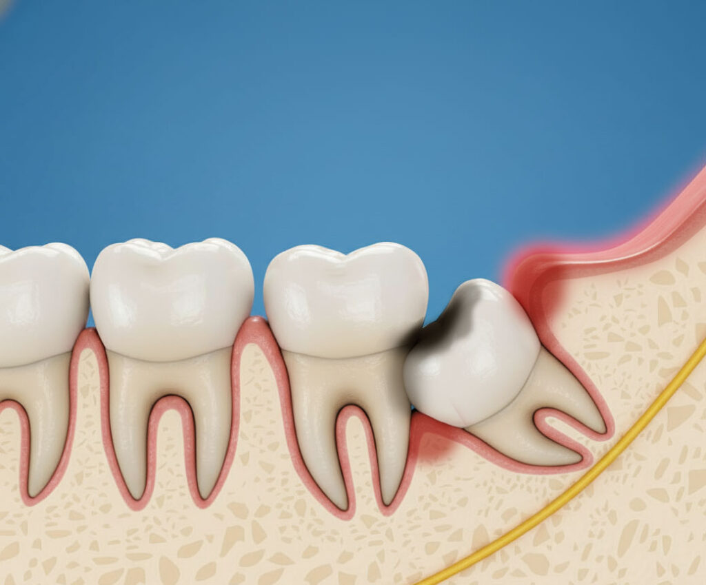 親しらず 横向き 大橋THREE歯科・矯正歯科