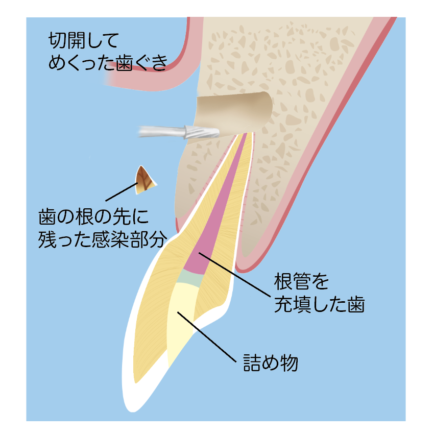 歯根端切除術解説イラスト 大橋THREE歯科・矯正歯科