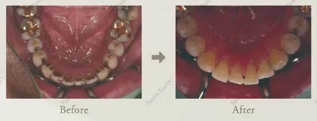 エアフローのビフォーアフター画像　大橋THREE歯科・矯正歯科