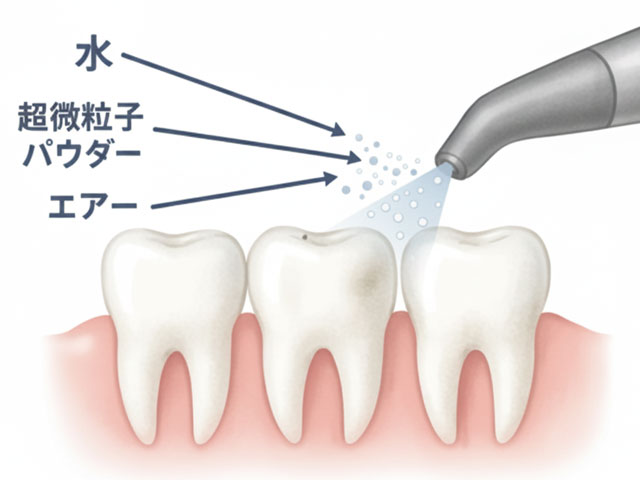 エアフロー　イラスト　大橋THREE歯科・矯正歯科