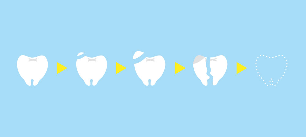歯ぎしりの悪化段階　イメージ図　大橋THREE歯科・矯正歯科