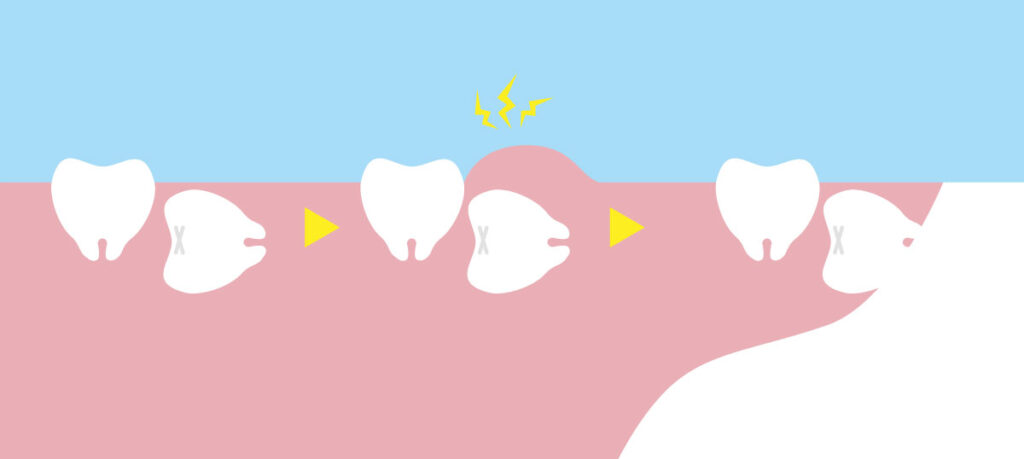 親知らずの経年悪化　イメージ図　大橋THREE歯科・矯正歯科　