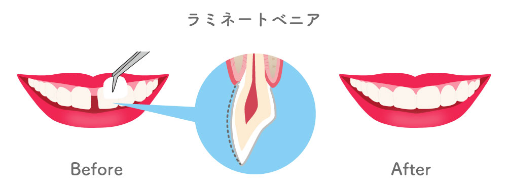 ラミネートベニア図解　大橋THREE歯科・矯正歯科