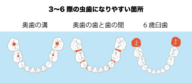 3〜6歳の虫歯ができやすい箇所
