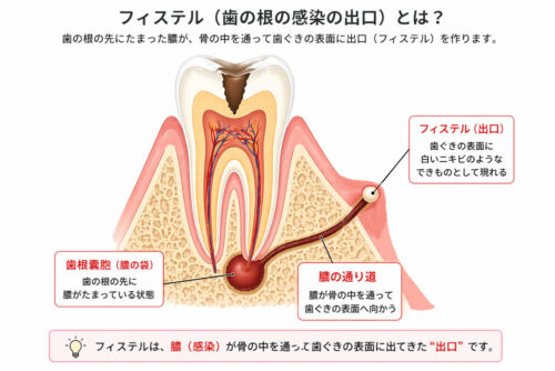 フィステル　解説画像
