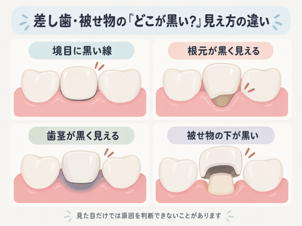 差し歯や被せ物が黒く見える場所の違いを示した図解