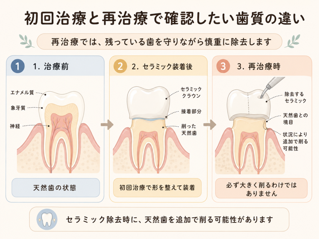 セラミックの再治療で天然歯を追加で削る可能性を示した模式図