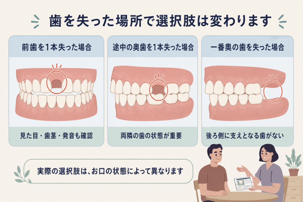 前歯・途中の奥歯・一番奥の歯を1本失った場合の治療選択の違い